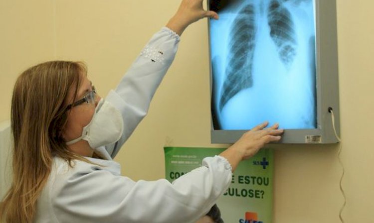 Governo cria comitê para eliminar a tuberculose